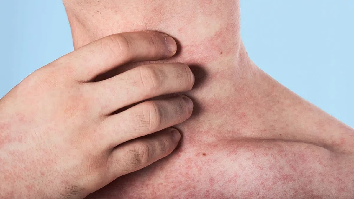 Measles Outbreak: Saskatoon Locations Identified